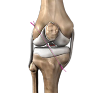 Anterior Cruciate Ligament ACL Reconstruction