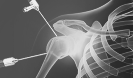 Arthroscopic Surgery