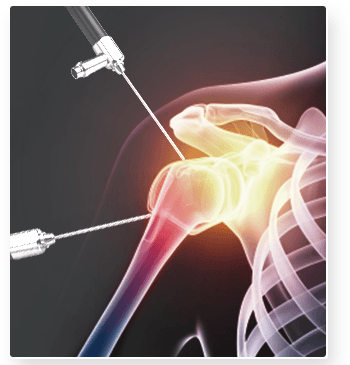 Arthroscopic Surgery