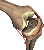 Meniscus Tear