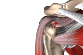 Rotator Cuff Repair