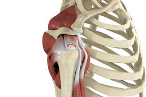 Rotator Cuff Tear