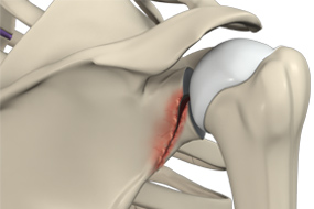 Shoulder Fracture