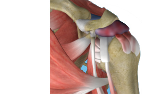 Shoulder Impingement